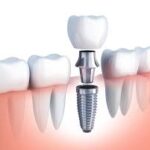 7本目 Implant againアメリカで歯医者シリーズ